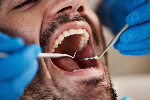 Best Emergency Dentist for Lost Fillings or Crowns in Granger, WA